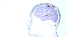 A device sitting on top of an illustration of a brain with wires and electrical leads.