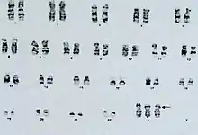 Chromosomes numbered 1 to 46, all with 2 copies except the X chromosome with 3