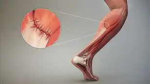 3D Medical Animation Depicting Strain