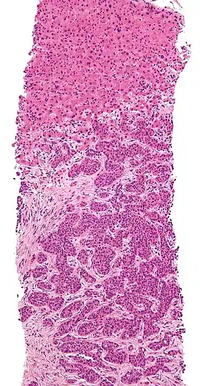 Micrograph of a liver core needle biopsy showing metastatic cancer.