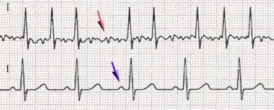 Afib ecg