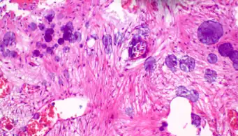 Air bubble entrapment artifact in a shoulder joint biopsy