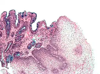 [Micrograph] of normal stratified squamous epithelium and the metaplasic epithelium of Barrett's esophagus (left of image). Alcian blue stain.