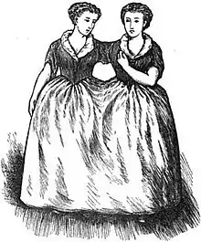 Two women conjoined at the shoulder and waist