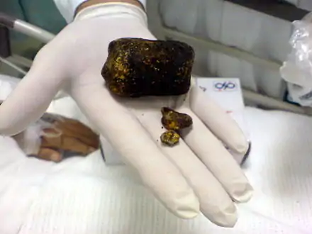 Large gallstone