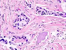 Histopathology of invasive ductal carcinoma of the breast representing a scirrhous growth. Core needle biopsy. Hematoxylin and eosin stain.