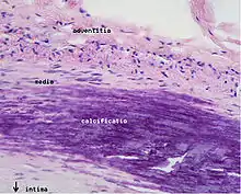 Microphotography of arterial wall with calcified (violet colour) atherosclerotic plaque (haematoxillin and eosin stain)