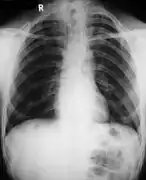 Poor development of the clavicles and a bell-shaped rib cage in a person with CCD