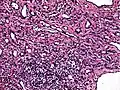 High power view showing a vascular tumor with cuboidal endothelium lining the vessels. Few entrapped seminiferous tubules are also noted (arrow).