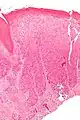 Micrograph of differentiated vulvar intraepithelial neoplasia. H&E stain.