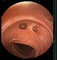 Colonic diverticulum