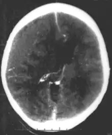 Nontraumatic epidural hematoma in a young woman. The grey area in the top right is organizing hematoma, causing midline shift and compression of the ventricle.