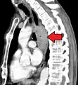 Esophageal cancer