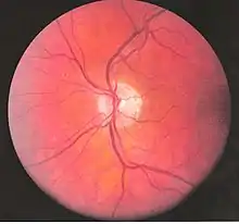 Left eye blood vessels