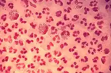 Gram-stain of gonococcal urethritis. Note distribution in neutrophils and presence of both intracellular and extracellular bacteria. (CDC)