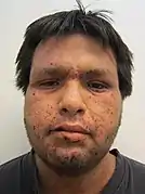 A severe case of facial impetigo