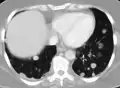 Metastatic cancer in the lungs