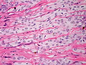 Poorly differentiated, where attempts at keratinization are often no longer evident. This is a clear-cell squamous-cell carcinoma. The dysplastic cells infiltrated cords through the dermis. Poorly differentiated cSCC has greatly enlarged pleomorphic nuclei showing a high degree of atypia and frequent mitoses.