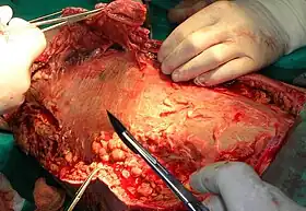 Necrotic tissue from the left leg surgically removed