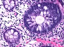 Normal (left) versus dysplastic (large at right) colonic crypts, the latter conferring a diagnosis of a tubular and/or villous adenoma.