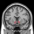 MRI coronal slice showing nucleus accumbens outlined in red