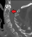 Type 3 odontoid fracture