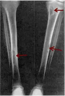 X-ray of a pair of human tibia, which run from the top right and left corner of the image into the bottom center, where they almost converge.  Small gray blemishes, identified as brown tumors, can be seen at the top and halfway down the right tibia and about three-quarters down the length of the left tibia.