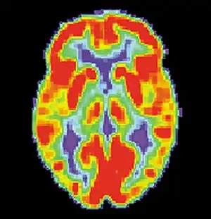 PET scan of a healthy brain - Image courtesy of US National Institute on Aging Alzheimer's Disease Education and Referral Center