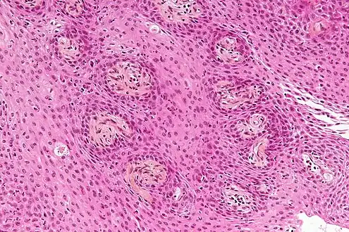 Micrograph showing a papillary craniopharyngioma, HPS stain