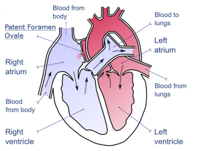 A drawing depicting a patent foramen ovale