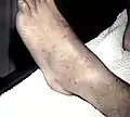 Petechiae on the lower extremities