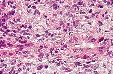 Primary biliary cirrhosis