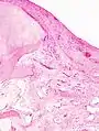 Histopathology of osteoarthrosis of a knee joint in an elderly female