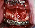 Rigid internal fixation of parasymphysis fracture of the mandible.  White arrow marks fracture, black arrow marks arch bar on lower teeth