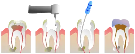 Root Canal Illustration Molar