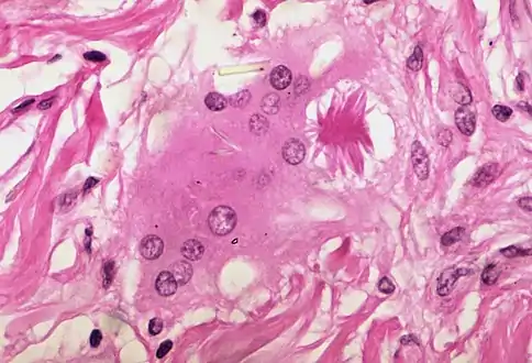 Asteroid body in sarcoidosis