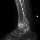 Lateral X-ray scan of ankle with secondary osteoarthritis