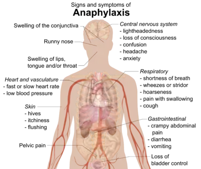 Signs and symptoms of anaphylaxis