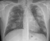 Xray of lungs, lighter patches visible