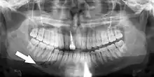 Panoramic radiograph of a simple mandible fracture of the right mandibular body, minimally displaced.  Note that the teeth to the left of the fracture do not touch