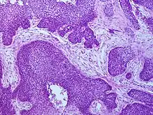 Basaloid squamous-cell carcinoma