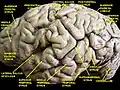 Cerebrum. Lateral view.Deep dissection.