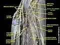 Radial recurrent artery