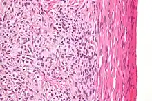 High magnification micrograph of a thecoma. H&E stain.