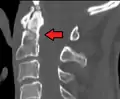 Type 2 dens fracture