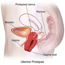 The uterus in pelvic region sags and presses against the vaginal wall.