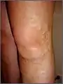 Varicose Anterior accessory saphenous vein at the knee