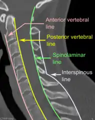 CT scan of normal congruous vertebral lines.