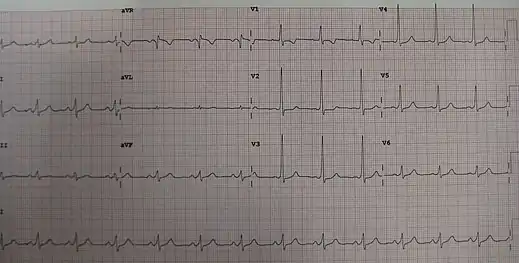 A short PR in Wolff–Parkinson–White syndrome